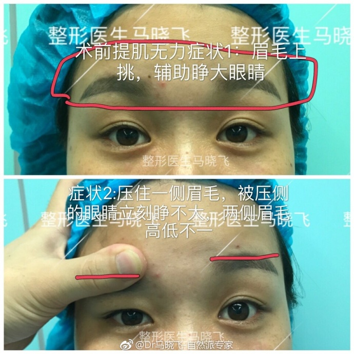 眼部肌无力玩手机游戏_眼肌无力可以锻炼好吗_眼睛肌无力可以锻炼吗