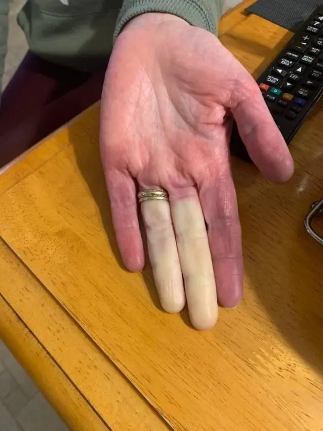 玩手机打游戏大拇指疼-玩手机游戏别再疼大拇指!这些小技巧帮你轻松应对(图3) 玩手机打游戏大拇指疼_玩手游大拇指痛_拇指玩手机痛