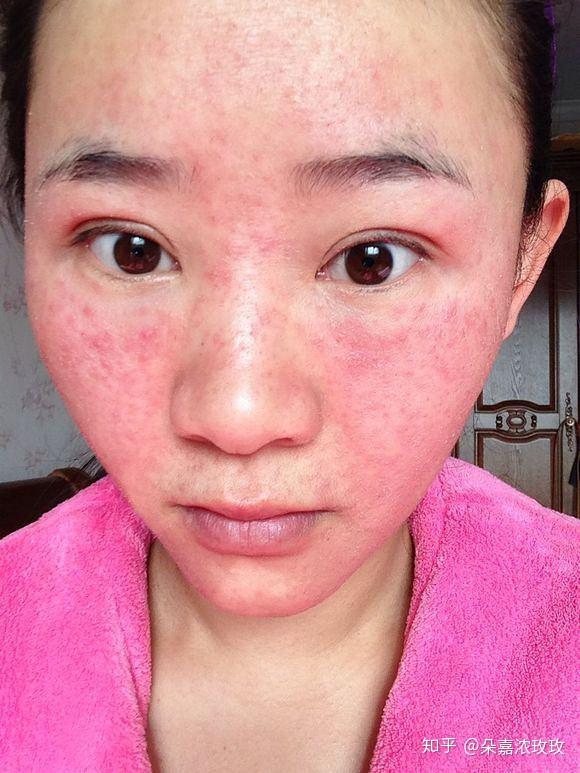 打游戏打的脸发烫_玩手机打游戏脸发烫_打游戏脸部发烫