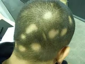 游戏会斑秃,揭秘虚拟世界背后的健康危机(图2) 游戏会斑秃,揭秘虚拟世界背后的健康危机(图2)