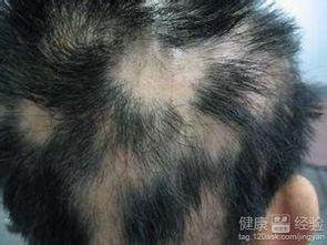 游戏会斑秃,揭秘虚拟世界背后的健康危机(图3) 游戏会斑秃,揭秘虚拟世界背后的健康危机(图3)