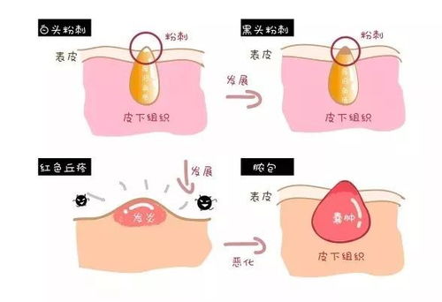 挤闭口游戏,一场趣味与健康的完美结合(图2) 挤闭口游戏,一场趣味与健康的完美结合(图2)